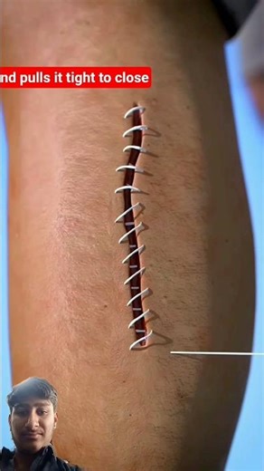 HOW stitches work 😮#short #dshu