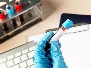 कोविड पॉजिटिव मरीजों के लिए क्यों जरूरी है D-Dimer टेस्ट? जानें डी-डाइमर टेस्ट के बारे में सबकुछ