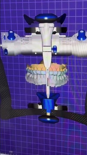 Michigan Splint by K-Dental Lab #splint #dentallab #digitaldentistry