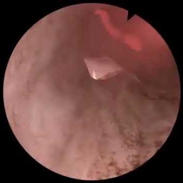 TURP procedure . Surgery for PROSTATE gland - DR Ashish chhajed