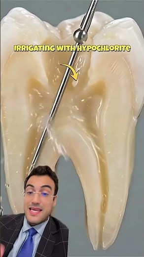 EXTRAIR O DENTE É MELHOR DO QUE FAZER CANAL?