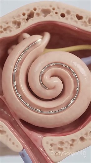 How Cochlear Implant Surgery Restores Hearing