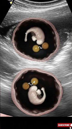 4 Weeks Pregnant: What a Baby Looks Like in the Womb