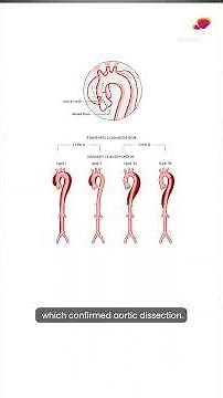 How a Torn Blood Vessel Near the Heart Is Treated | Aortic Dissection | Kauvery Hospital Trichy