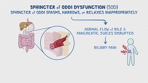 Video: Sphincter of Oddi dysfunction: Year of the Zebra 2024 - Video Explanation! | Osmosis | Osmosis