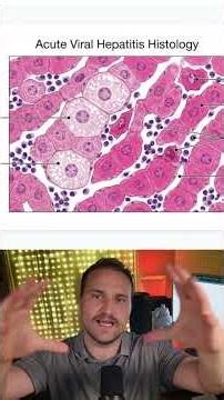 Acute Viral Hepatitis Histology #usmle