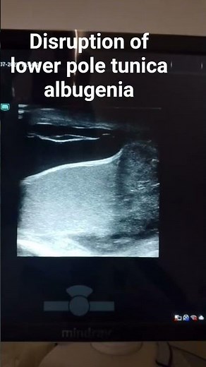 testicular rupture
