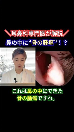 【耳鼻咽喉科専門医が解説】鼻の中の“骨腫瘍”を内視鏡で摘出！副鼻腔で育つ腫瘍とは｜名古屋市港区・中川区 ふくしまみなと耳鼻咽喉科 #shorts