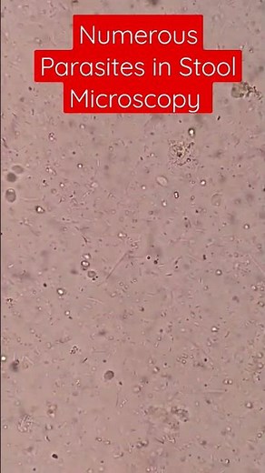 Plenty of Live Parasites in Stool Microscopy