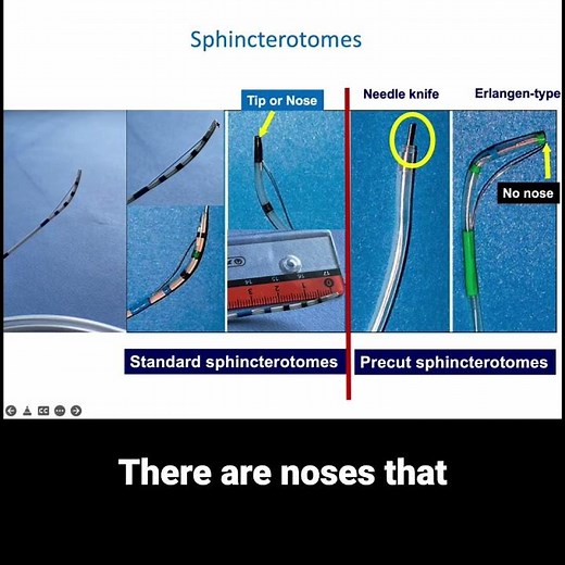 ERCP Cannulation: Bowing the Biliary Catheter