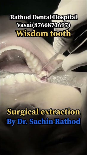 😲🦷“How Impacted Wisdom Teeth Are Surgically Removed”#wisdomtoothremoval#extraction#dentist#surgery