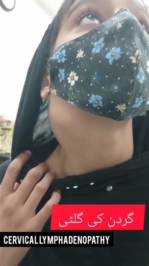 Neck Swelling | Cervical Lymphadenopathy 😮 #neckswelling #cervicallymphadenopathy #ent #entdr #dr