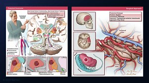 #412: Transsylvian Transinsular Approach for a Putaminal Basal Ganglia Cavernous Malformation Resection - Cavernous Malformation - Seven Series Collection