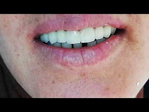 Zirconia Full Mouth. Upper Dental Bridge