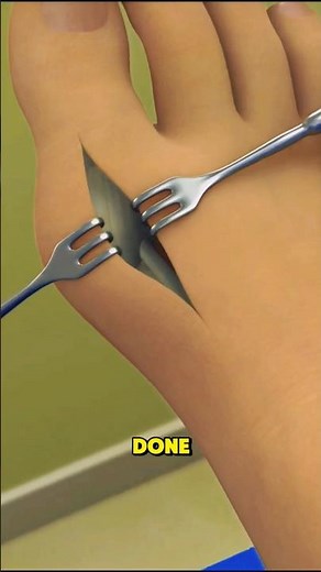 Bunionectomy or Bunion Surgery: 3d animation #medicalanimation