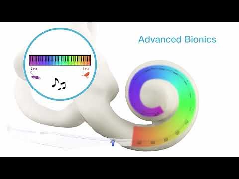 Advanced Bionics sound processing for better sound quality