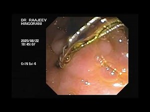 ercp stent removal