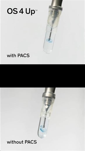 PACS: The difference in phaco surgery #cataract #ophthalmology #eyesurgery