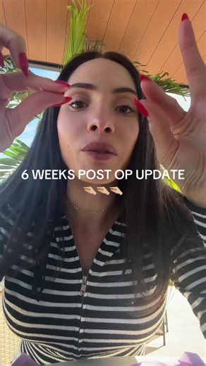 6 Weeks Post Breast Augmentation: Progress Update