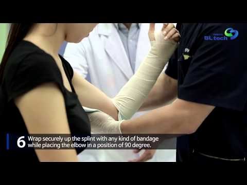 [APPLICATION VIDEO] LONG ARM SPLINT