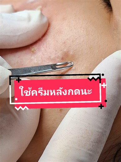 เทคนิคการกดสิวจากพี่กุ้ง