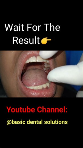 new teeth #dental #teethdecay #whiteningtoothpaste #dentalclinic #smiledesigndental