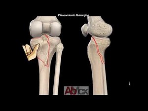 Platillo Posteromedial Placa Antideslizante Posterior