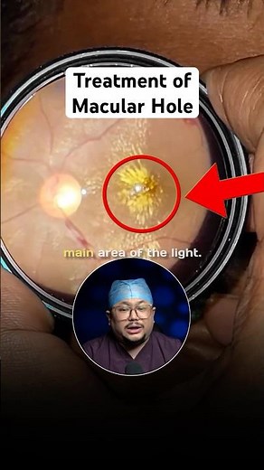 Treatment of Macular Hole in Eyes #factsinhindi #retinasurgery #eyes #shorts #eyehealth