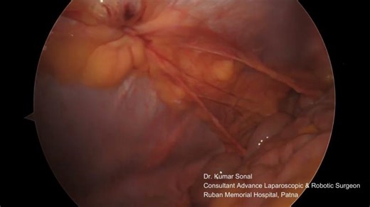 How does mesh look like after 2 years of laparoscopic groin hernia surgery? | Kumar Sonal