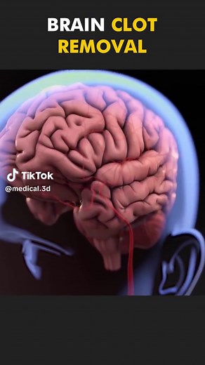 Brain Blood Clot Removal Technique 3D Animation