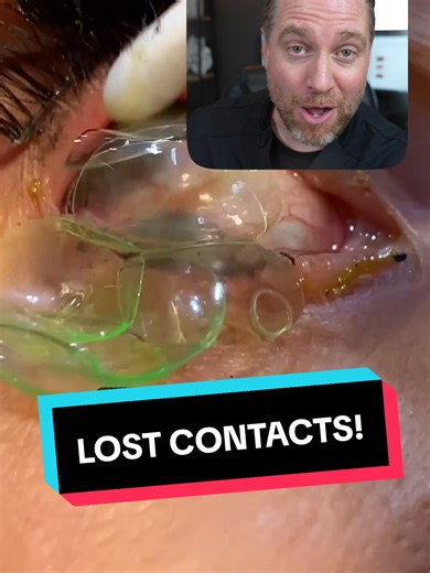 Lost Contact Lenses: Understanding Risks and Recovery