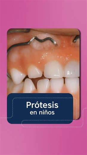 Fundacion Creo on Instagram: "Prótesis en niños: Diseños actuales 👶✨ La odontopediatría también necesita innovación ✅ Aprendé a diseñar prótesis pediátricas con enfoque clínico y práctico, pensando en la edad, colaboración y necesidades de cada paciente. 📌 En este curso vas a ver: 🦷 Desarrollo de la dentición primaria 🔹 Tipos de prótesis: fijas y removibles 👑 Coronas metálicas y estéticas 🧩 Mantenedores de espacio y aparatología 📊 Casos clí