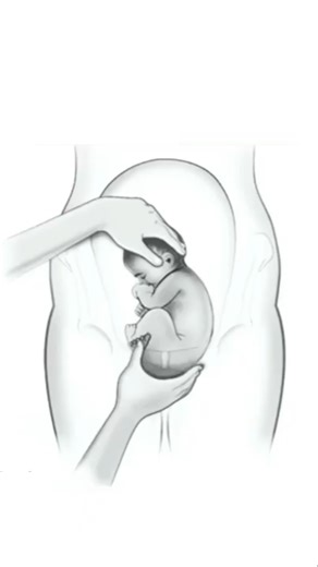 What Is ECV for a Breech Baby? ECV (External Cephalic Version) is a medical procedure used late in pregnancy to turn a baby from a breech position (bottom-first or feet-first) into a head-down position, which is safer for vaginal birth. #Pregnancy #Baby #Childbirth #Pregnant | Pregnant Life