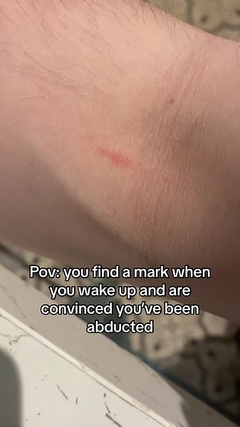 Anyone else sus about weird marks that appear when you wakeup and think you’ve been abducted by aliens? #pov #alien #abduction #alienabduction #alienabductionstories #alienromulus #thefourthkind #xeno #scary #scarystories #strange