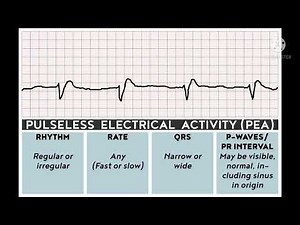 EKG PEA (Pulseless electrical activity)