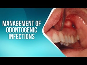 Management of Odontogenic Infections: 6 Effective Treatments