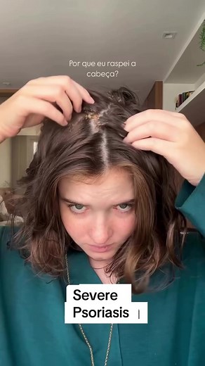 Psoriasis Scalp Care: Severe Psoriasis Tips