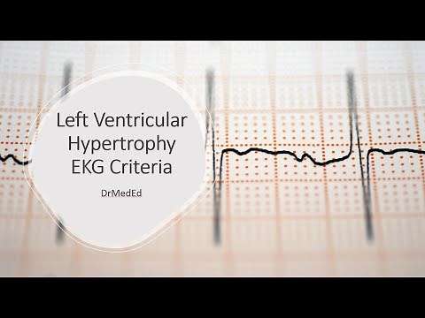 Left Ventricular Hypertrophy - EKG Criteria (Sokolow + Lyon & Cornell)