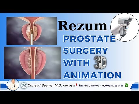 Rezum Prostate Surgery with 3D Animation