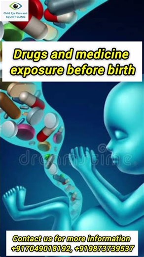 Squint surgery in india | Best squint treatment in india