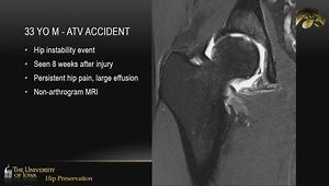 Femoral Head Osteochondral Allograft