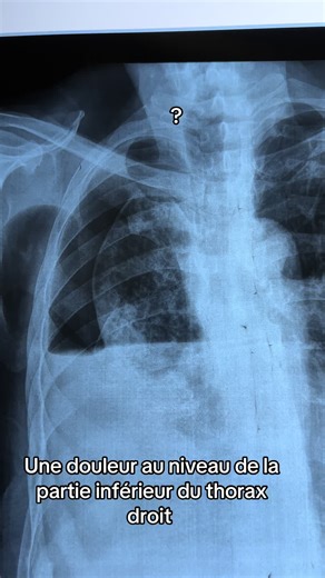 Douleur Thoracique : Signes et Solutions Médicales