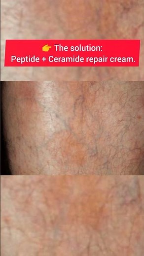 Skin Thinning from Steroid Creams? | Best Repair Cream Solution