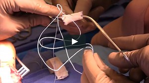 OTA Video Library - Achilles Tendon Reconstruction and FHL Transfer