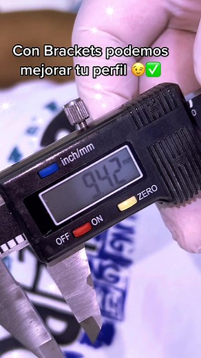 Corrección de perfil con brackets: solución para dientes hacia adelante