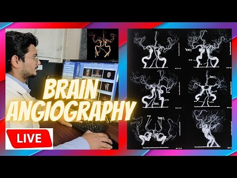 Live CT Scan Of Brain Angiography| Scanning and processing technique #radiologytechnologist #ctscan