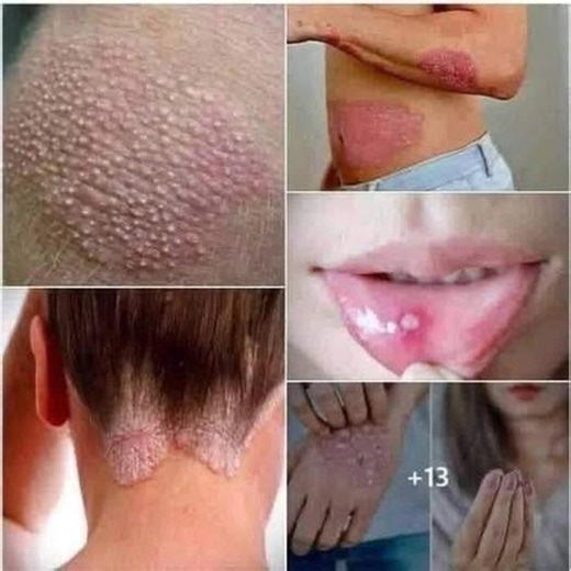 Signs of human papillomavirus that you should know and eat carefully... See More | Life in Motion