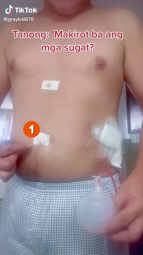 Laparoscopic Cholecystectomy: Gallbladder Removal Procedure Explained