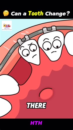 𝗛𝗲𝗮𝗹𝘁𝗵 | 𝗔𝗻𝗶𝗺𝗮𝘁𝗶𝗼𝗻 | 𝗕𝗼𝗱𝘆 on Instagram: "Do you ever wonder how a crooked tooth starts its journey to become straight again? 😬 Braces gently apply pressure to move teeth into the right position, improving your smile, bite, and confidence over time. ✨ It’s a slow but magical transformation! 👉 Save this & Follow @healthytoonhub for more fun dental & health animations! 💚 #dentalcare #braces #smilejourney #didyouknow #healthytooth #animation #healthfacts #teethcare #usareels #m