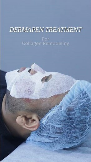 The magic of DermaPen – a skin treatment that boosts collagen, fades scars, and brings back glow.